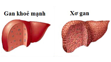 Viêm gan phát triển thành xơ gan