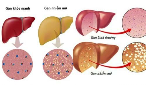 Gan nhiễm mỡ ăn gì, chế độ dinh dưỡng có ảnh hưởng như thế nào đến việc điều trị gan nhiễm mỡ