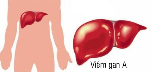 Các giai đoạn của bệnh viêm gan A