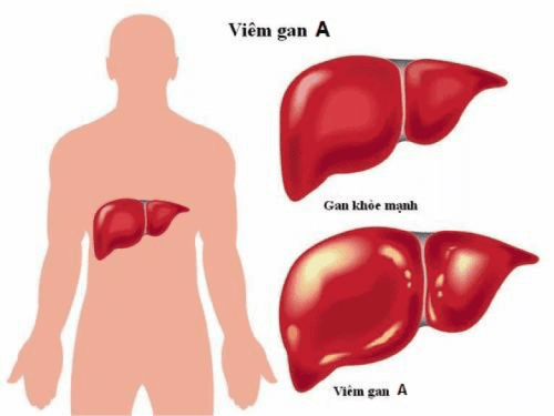 Bệnh viêm gan A lây qua đường nào?