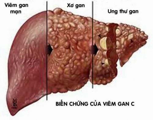 Bệnh viêm gan c có nguy hiểm không? Điều gì sẽ xảy ra nếu không chữa viêm gan C?