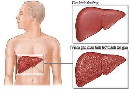 Các loại siêu vi dẫn tới viêm gan siêu vi