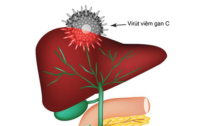 Hiện chưa có vắc-xin phòng ngừa virus viêm gan C