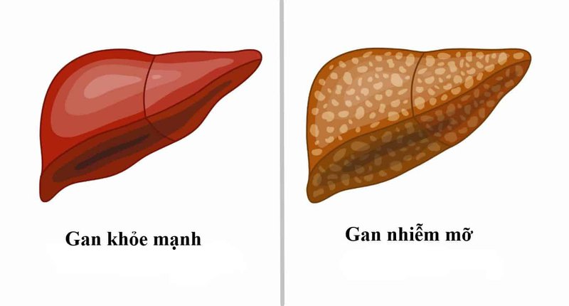 trị gan nhiễm mỡ bằng vỏ bưởi