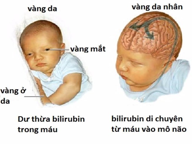 Bilirubin là nguyên nhân chính gây vàng da và ngứa da