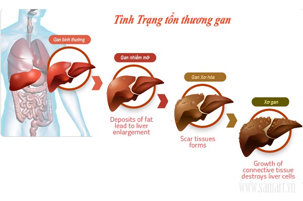 Tình trạng tổn thương gan