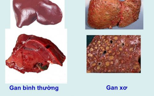 Gan bị xơ hóa