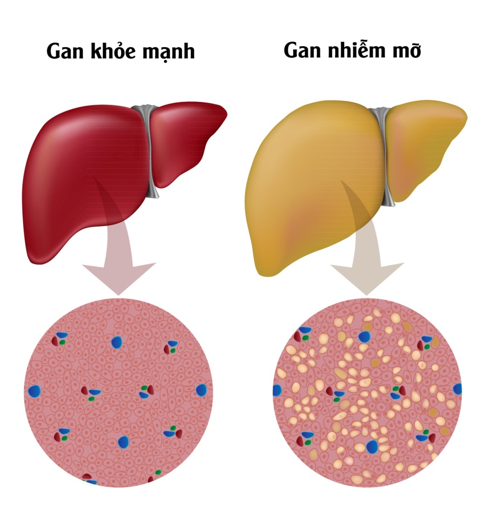 Biểu hiện của gan khỏe mạnh và gan nhiễm mỡ