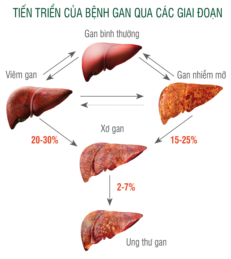 Quá trình chuyển hóa bệnh gan nhiễm mỡ