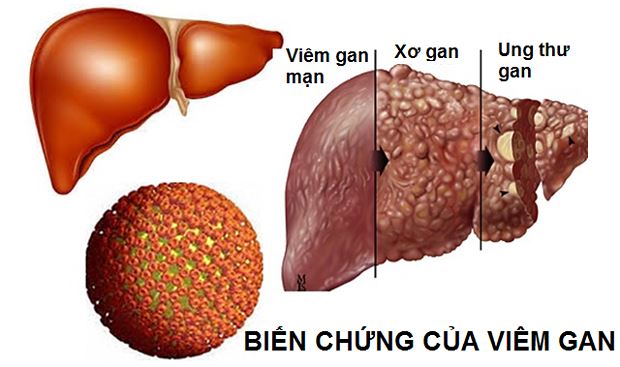 Những biến chứng của bệnh viêm gan B