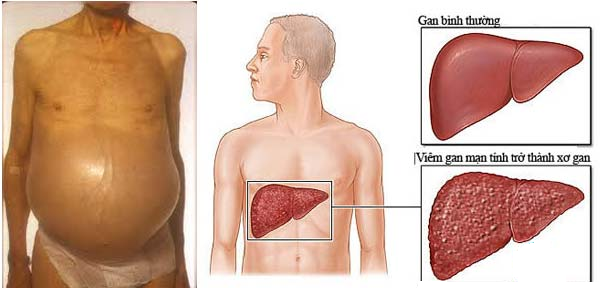 Viêm gan B là gì, nguyên nhân, triệu chứng và biến chứng của bệnh