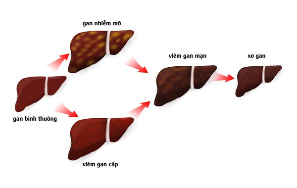 Biểu hiện của các chuyển biến của bệnh gan