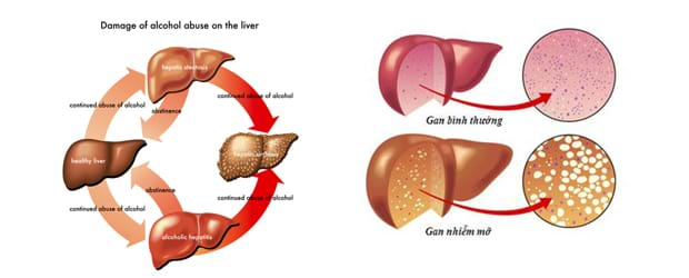 Bệnh gan nhiễm mỡ triệu chứng nào nguy hiểm?