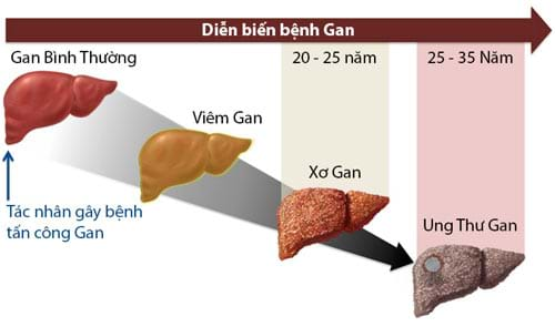 Diễn biến bệnh viêm gan B