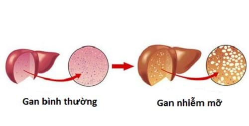 Những biện pháp đẩy lùi bệnh gan nhiễm mỡ