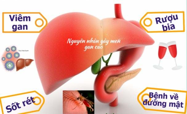 Các nguyên nhân men gan tăng chủ yếu