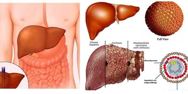 Bệnh viêm gan siêu vi B là gì và những thông tin cần biết