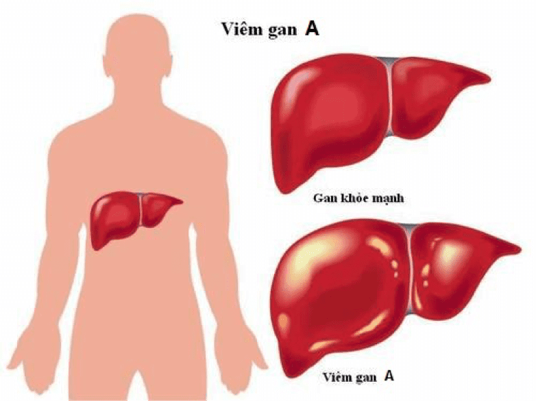 Bệnh viêm gan virus A có thể tự khỏi nếu người bệnh có chế độ sinh hoạt và ăn uống hợp vệ sinh