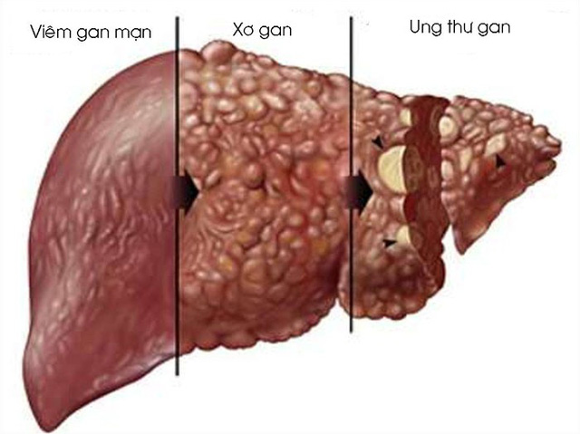 viêm gan mãn tính là gì